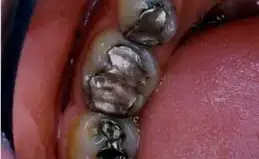 Ceramic Inlays & Onlays Before & After Smile Gallery