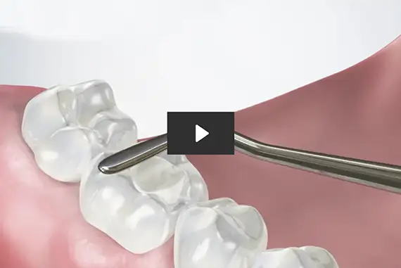 Dental fillings displayed, showcasing various types and colors.