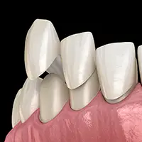 Composite Veneers (Direct Chairside Veneers)