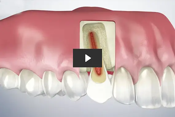 Illustration of a dentist performing a root canal procedure on a patient.