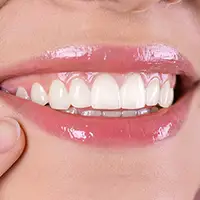 Gum Contouring