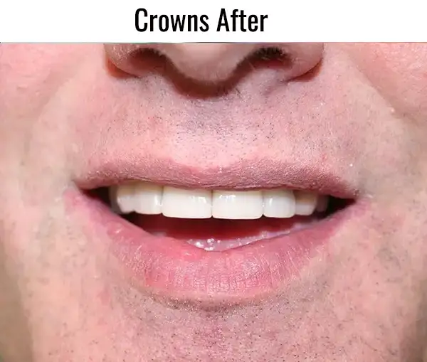 crowns after