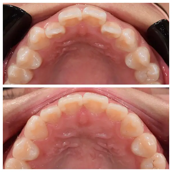 Invisalign Treatment Before & After