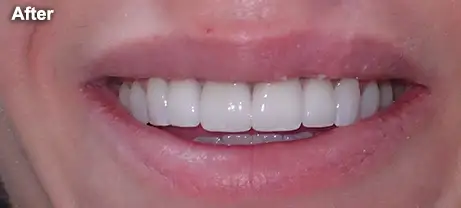 Before & After Smile