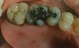 Ceramic Inlays & Onlays Before & After Smile Gallery