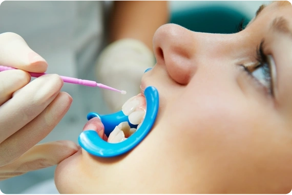 Dental sealants