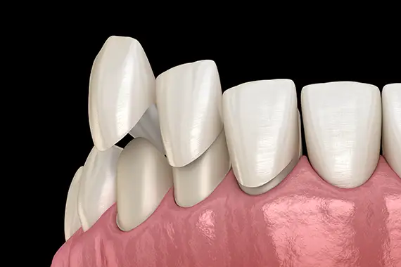 Veneers result