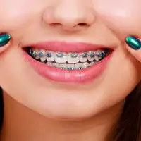 Braces fitted on teeth showcasing orthodontic treatment.