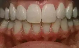 Whitening Before & After Smile Gallery