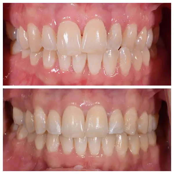 Invisalign Treatment Before & After