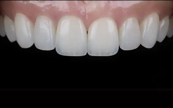 Before and After