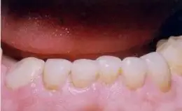 Veneers Before & After