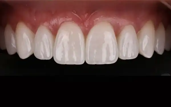 Before and After