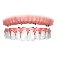 Overdentures
