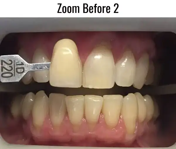 Zoom Before 2
