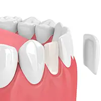 Neer Veneers