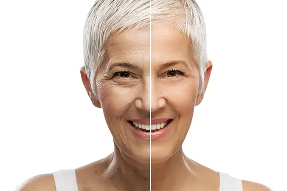 Anti-Wrinkle Botox