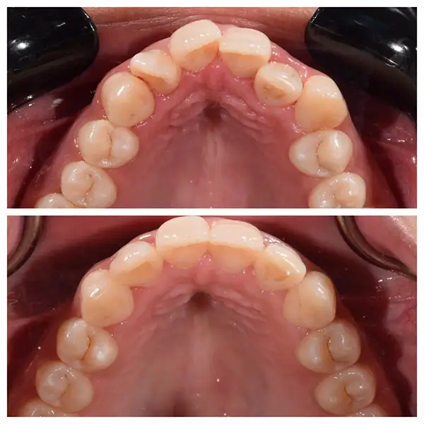 Invisalign Treatment Before & After