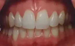 Whitening Before & After Smile Gallery