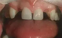 Dental Implants Before & After