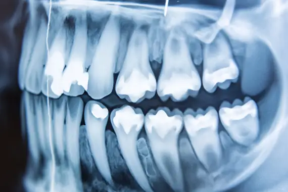 Digital Bitewing and Periapical X-Rays