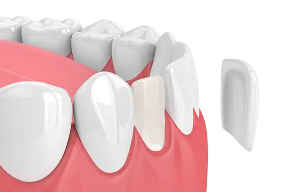 Smiling person showcasing bright, perfect teeth enhanced by veneers.