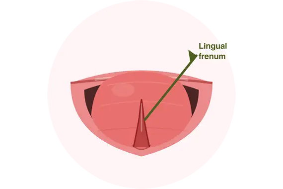 Tongue-Tie Treatment