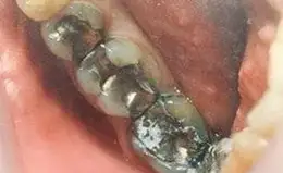 Crowns Before & After