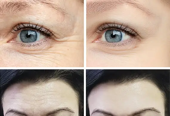 Patients concerned with removing wrinkles and fine lines.