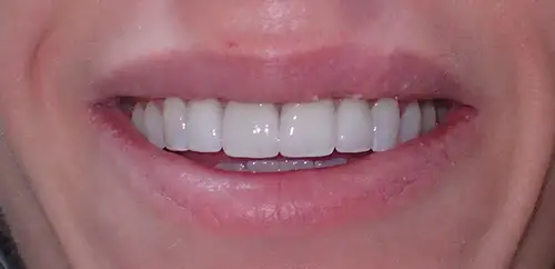 After Smile and Bite