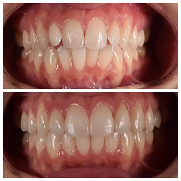 Invisalign Treatment Before & After
