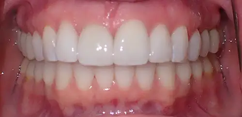 After Smile and Bite