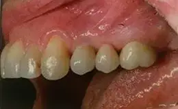 Bridges Before & After Smile Gallery 