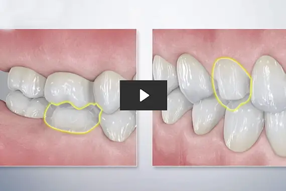 Ceramic dental crown being fabricated with advanced technology.