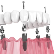 All-On-4 Implants