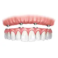 Implant-Supported Dentures