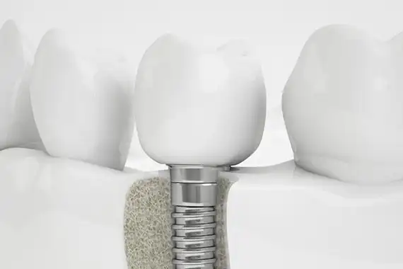 Benefits of implant restorations 