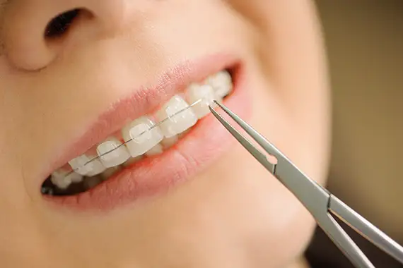 Ceramic & Clear Braces