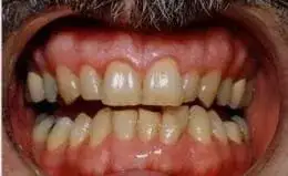 Whitening Before & After Smile Gallery