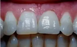 Bonding Before & After Smile Gallery