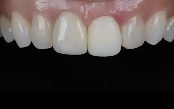 Before and After