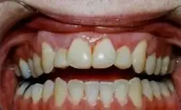 Veneers Before & After