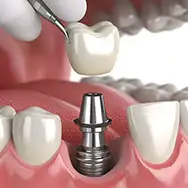 Dental professional placing a crown on a dental implant.