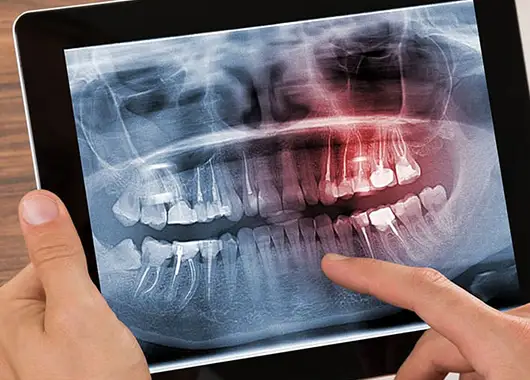 Digital X-Rays