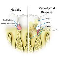Periodontal Treatment