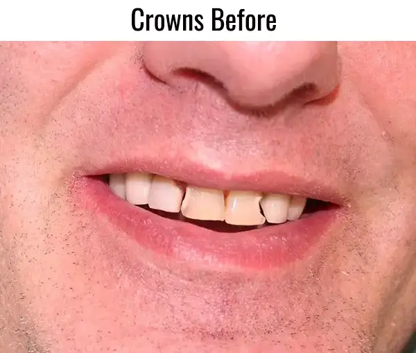 crowns before