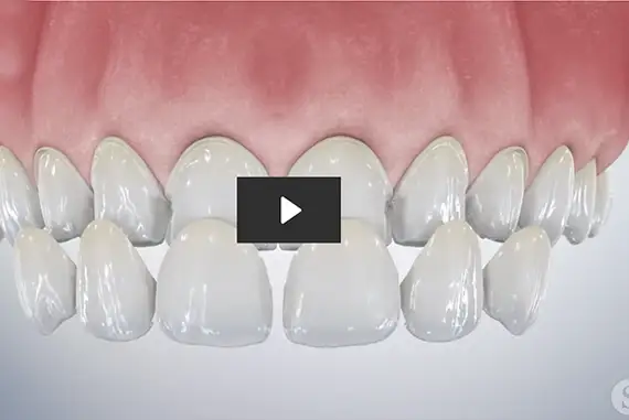 Smiling person showcasing bright, perfect teeth enhanced by veneers.