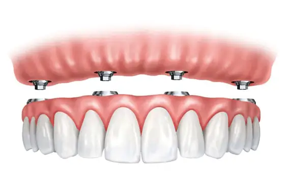 Implant-Supported Dentures