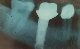 Dental Implants Before & After
