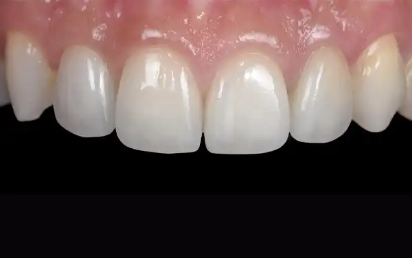 Before and After